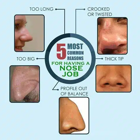 rhinoplasty - nose correction surgery