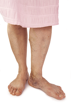 varicose veins removal