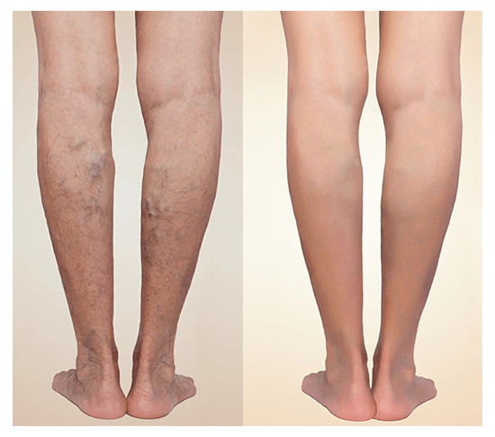 varicose veins treatment