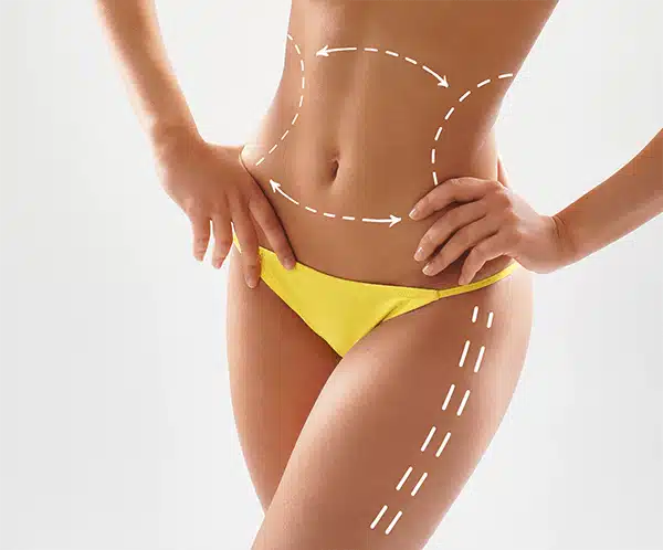 Advanced Vaser Liposuction Procedure