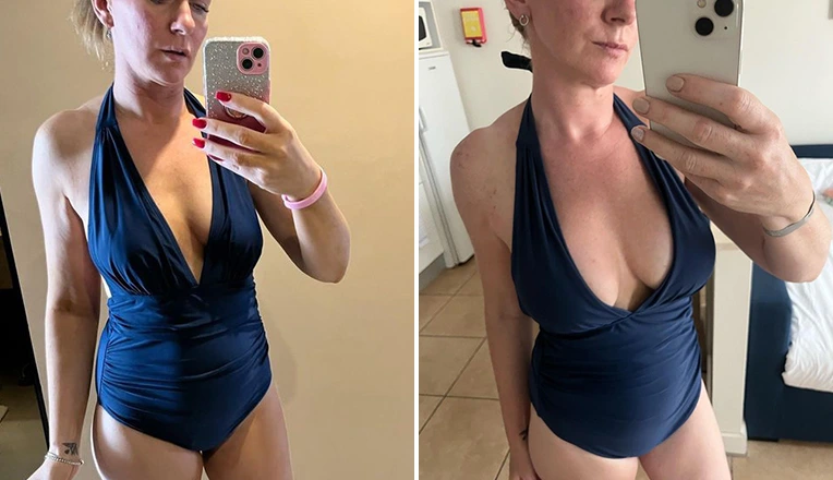 breast-augmentation-before-and-after