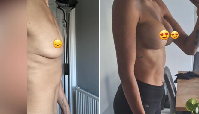 breast augmentation patient results-1