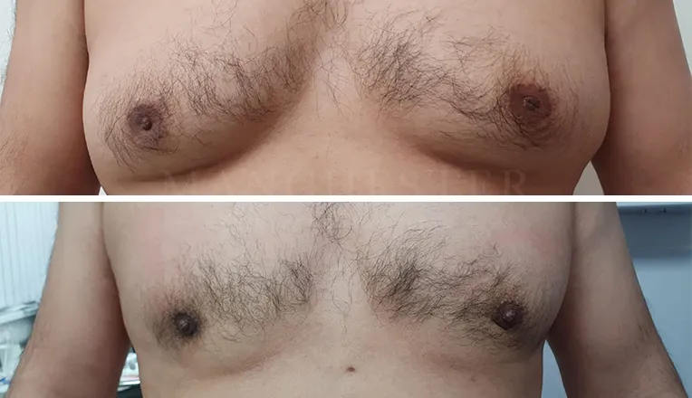 gynecomastia-liposuction-before-and-after-patient-6