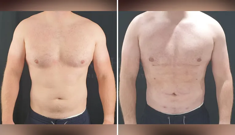 gynecomastia-liposuction-before-and-after-patient