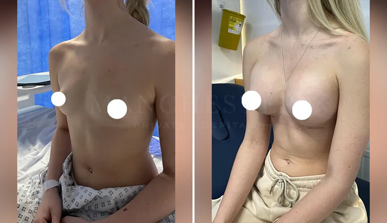 breast-enlargement-patient-4