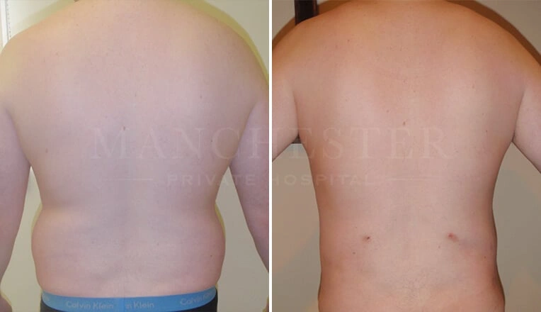vaser-lipo-male-before-and-after-7