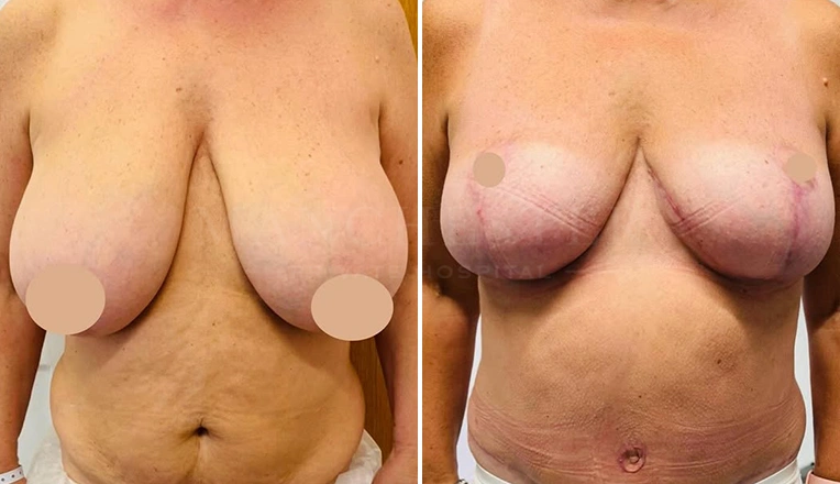 abdominoplasty-combines-with-vaser-liposuction-and-breast-reduction