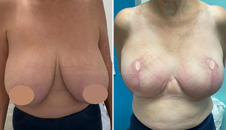 breast-reduction-before-and-after