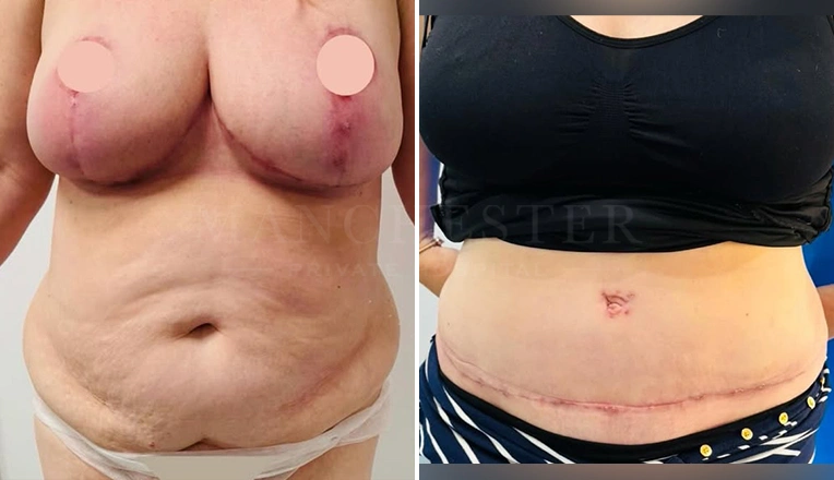 breast-reduction-full-tummy-tuck-and-vaser-liposuction