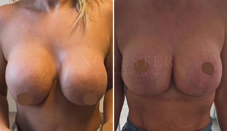 breast-uplift-before-and-after