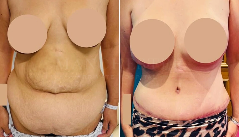 full-tummy-tuck-and-liposuction