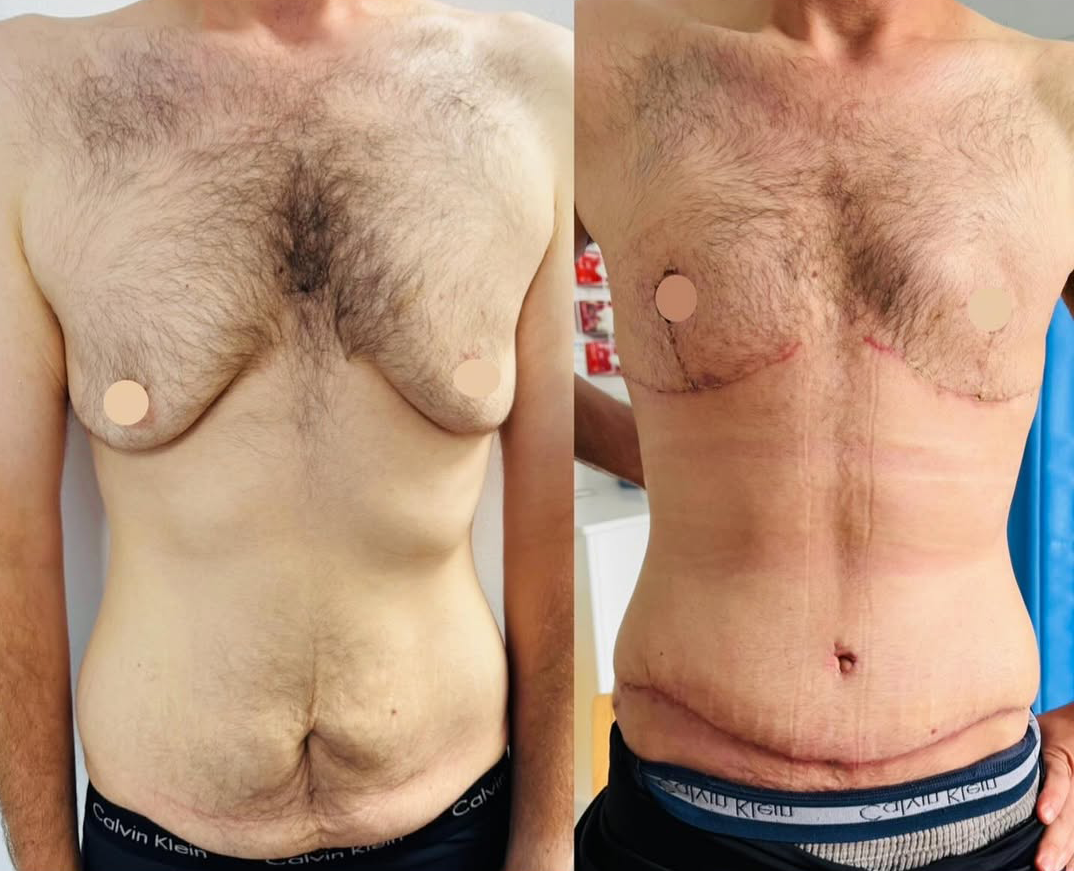 Gynaecomastia Breast Reduction and Male Tummy Tuck Before and After