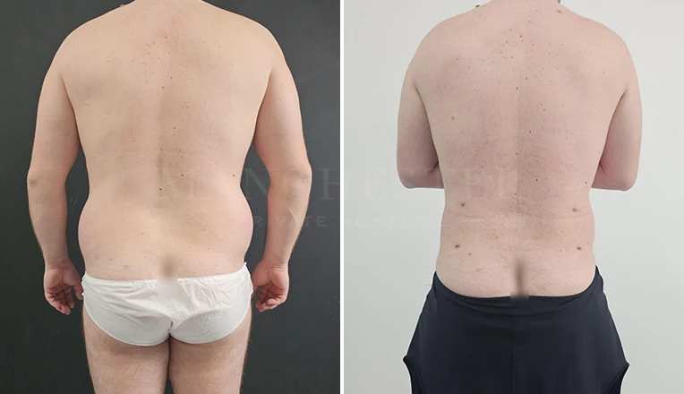 men-love-handle-liposuction-before-and-after