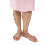 varicose-veins-jpg