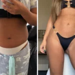 Vaser Liposuction Patient Journey and Testimonial: Daniella