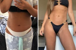 Vaser Liposuction Patient Journey and Testimonial: Daniella