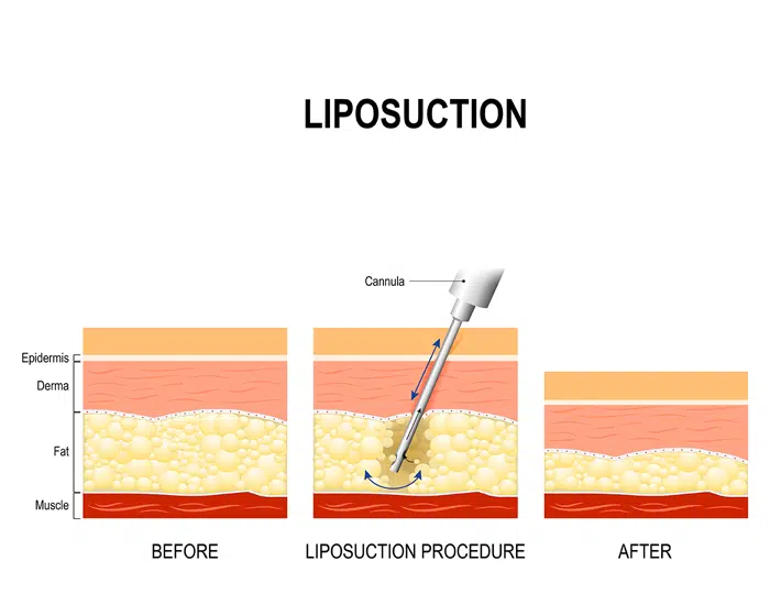 liposuction procedure