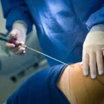 What is liposuction?