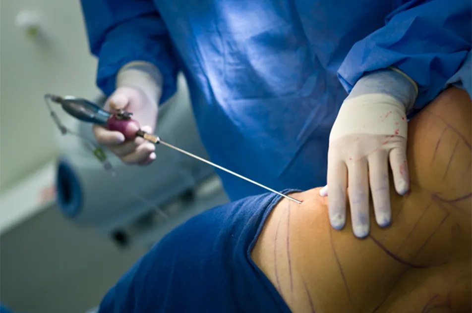 a person partway through a liposuction procedure