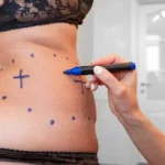 a liposuction surgeon marks out where incisions will be made on a woman’s abdomen