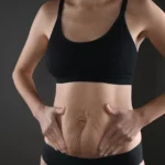 a woman with stretch marks and loose skin on her abdomen cups her tummy