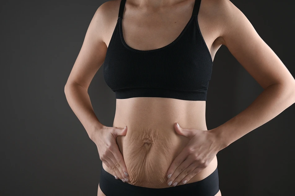 a woman with stretch marks and loose skin on her abdomen cups her tummy