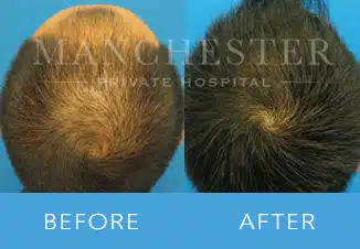 Hair Transplant 1