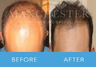 Hair Transplant 3