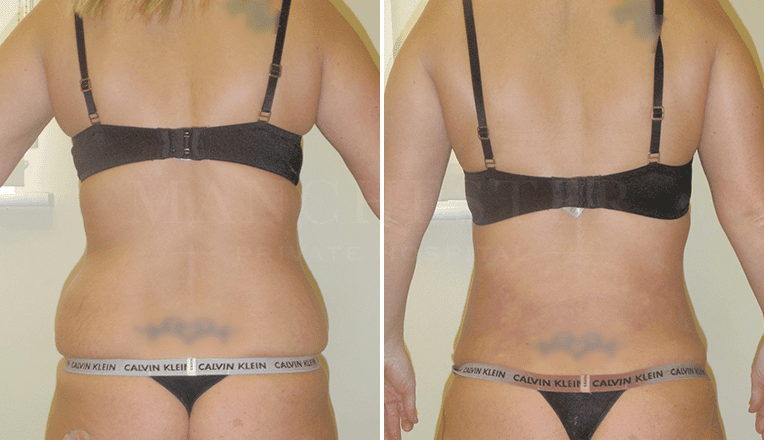 back vaser liposuction before and after