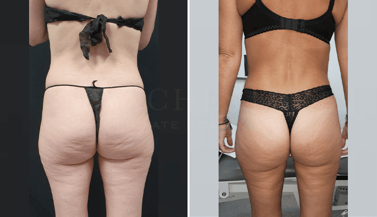 back vaser liposuction before and after