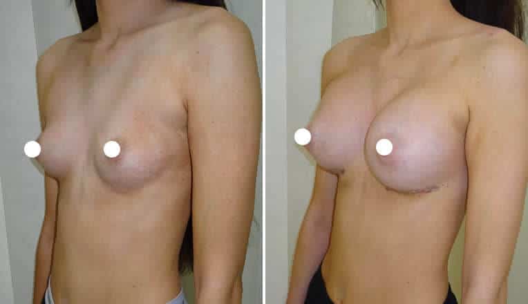 boob job before and after