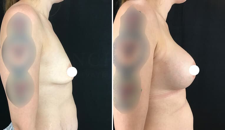 boob job before and after