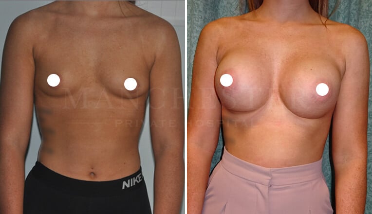 breast augmentation before and after