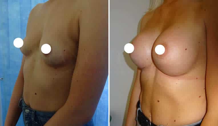 breast augmentation before and after