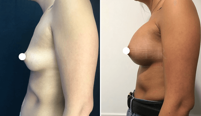 breast augmentation before and after