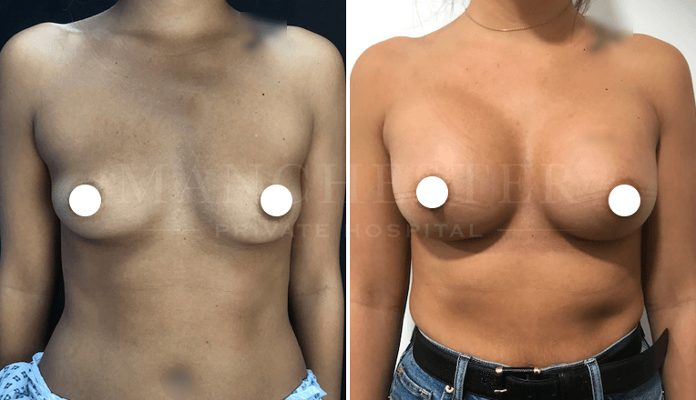 breast augmentation before and after