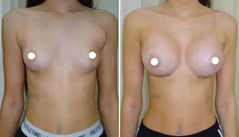 breast enlargement manchester before and after