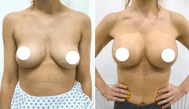 breast enlargement manchester before and after