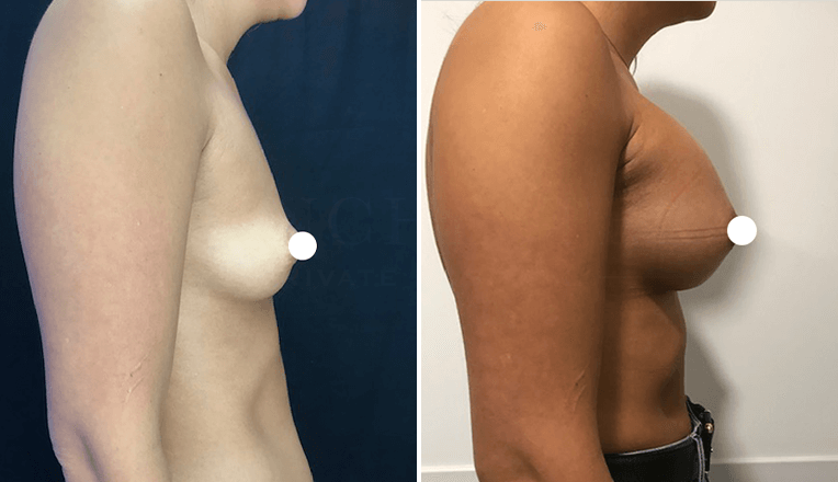 breast enlargement before and after