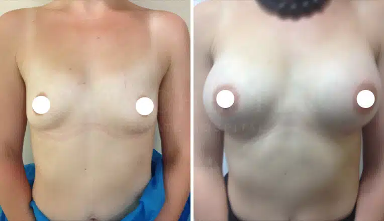 breast enlargement before and after