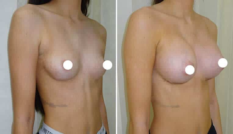 breast enlargement before and after