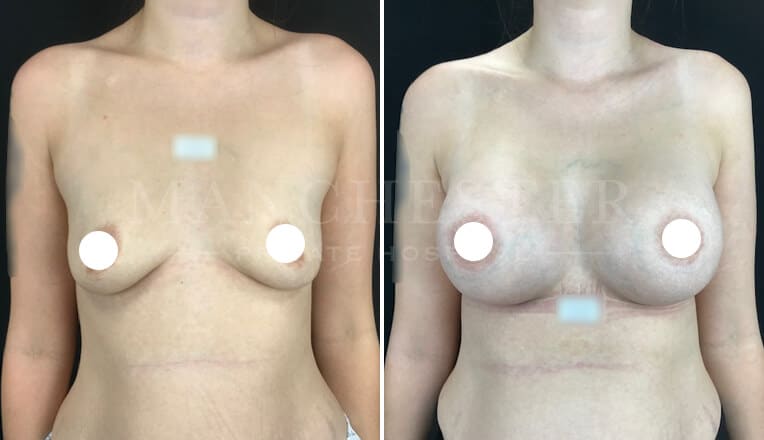 breast enlargement before and after