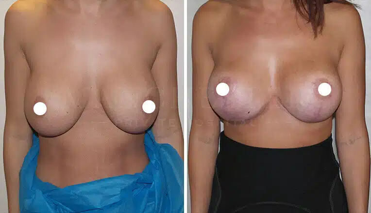 breast lift before and after