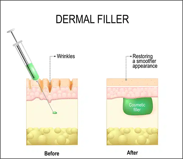 dermal-filler