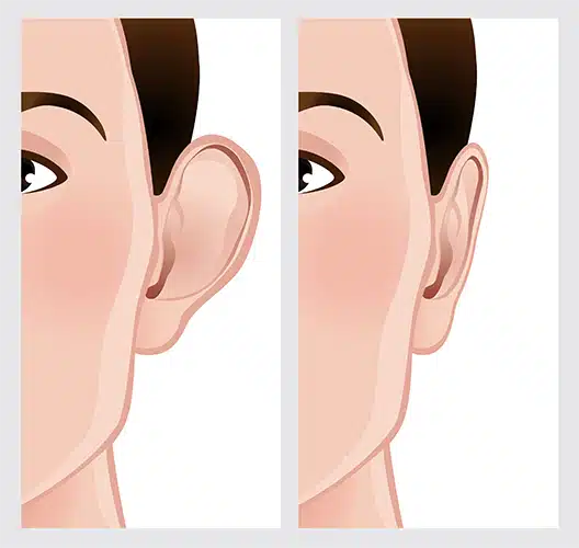 ear-correction