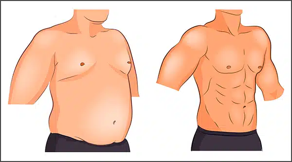 gynecomastia