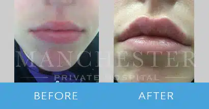 lip filler before and after