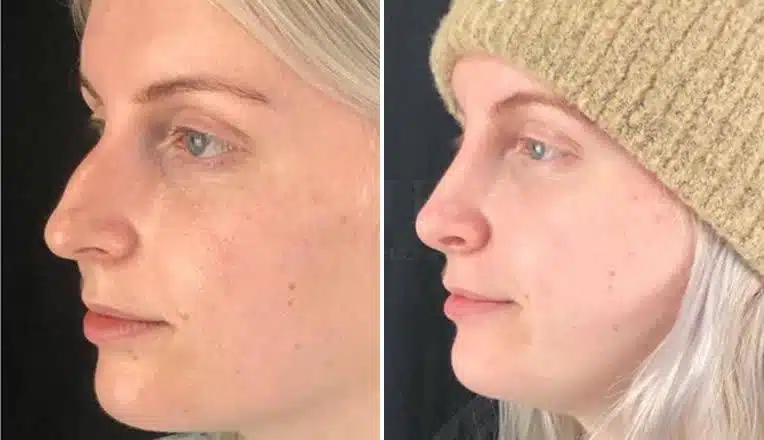 nose correction before and after