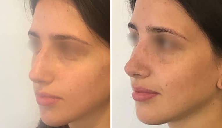 nose job before and after