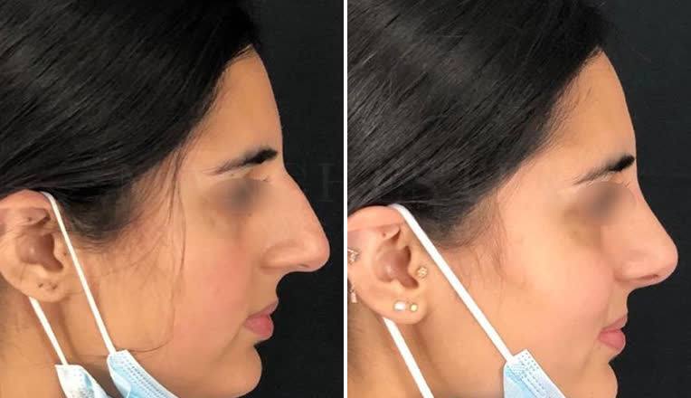 nose reshaping before and after